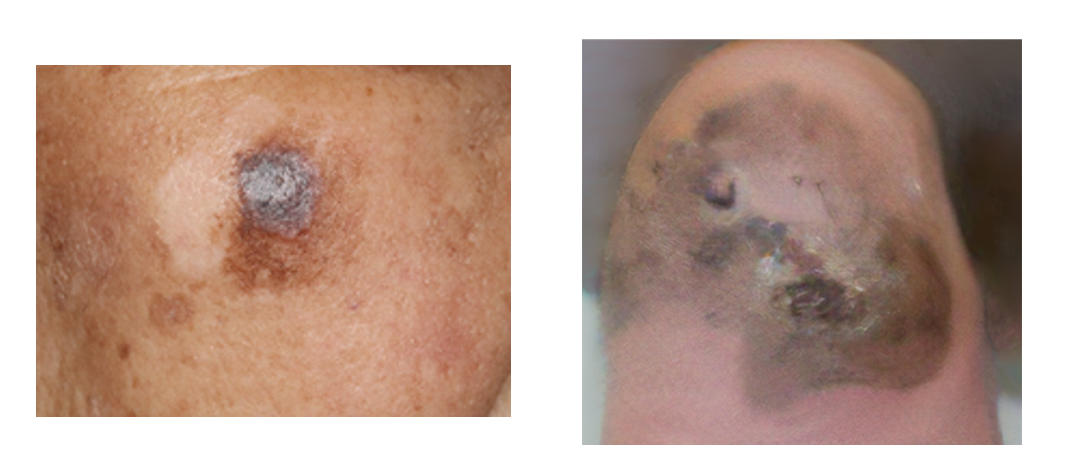 アメラノーマ性黒色腫は予防可能ですか?